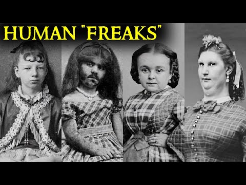 Tragic “Human Freak” Stories you wouldn’t believe