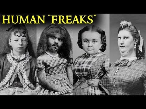 Tragic “Human Freak” Stories you wouldn’t believe