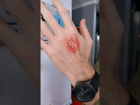 SPIDER BITES BOY! #shorts